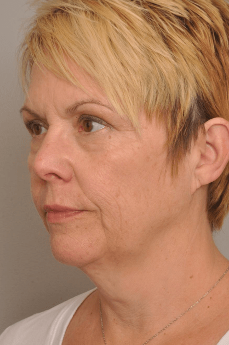 Lower Facelift/Necklift Delaware | Premier Cosmetic Surgery DE