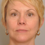 Lower Facelift/Necklift Delaware | Premier Cosmetic Surgery DE