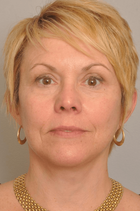 Lower Facelift/Necklift Delaware | Premier Cosmetic Surgery DE