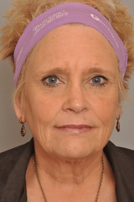 Lower Facelift/Necklift Delaware | Premier Cosmetic Surgery DE