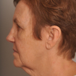 Lower Facelift/Necklift Delaware | Premier Cosmetic Surgery DE