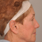 Lower Facelift/Necklift Delaware | Premier Cosmetic Surgery DE