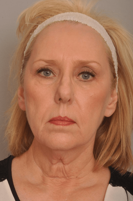 Lower Facelift/Necklift Delaware | Premier Cosmetic Surgery DE