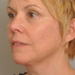 Lower Facelift/Necklift Delaware | Premier Cosmetic Surgery DE