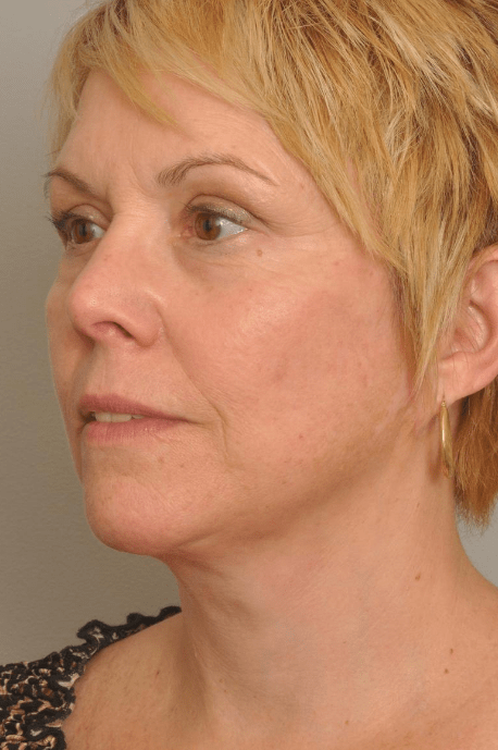 Lower Facelift/Necklift Delaware | Premier Cosmetic Surgery DE