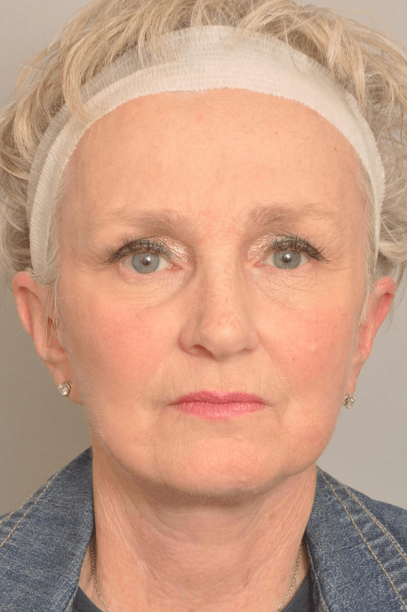 Lower Facelift/Necklift Delaware | Premier Cosmetic Surgery DE