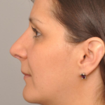 Rhinoplasty Delaware | Premier Cosmetic Surgery DE