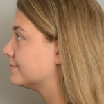 Rhinoplasty Delaware | Premier Cosmetic Surgery DE