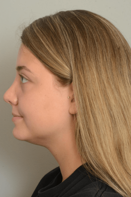 Rhinoplasty Delaware | Premier Cosmetic Surgery DE