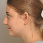 Rhinoplasty Delaware | Premier Cosmetic Surgery DE