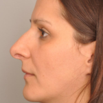 Rhinoplasty Delaware | Premier Cosmetic Surgery DE