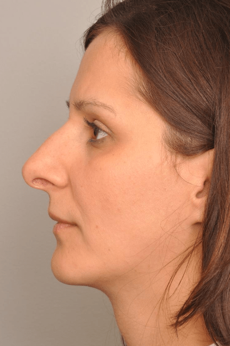 Rhinoplasty Delaware | Premier Cosmetic Surgery DE