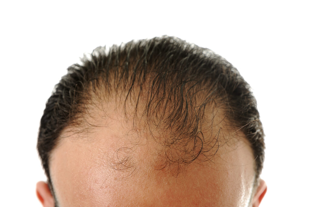 Hair Restoration Delaware | Premier Cosmetic Surgery DE