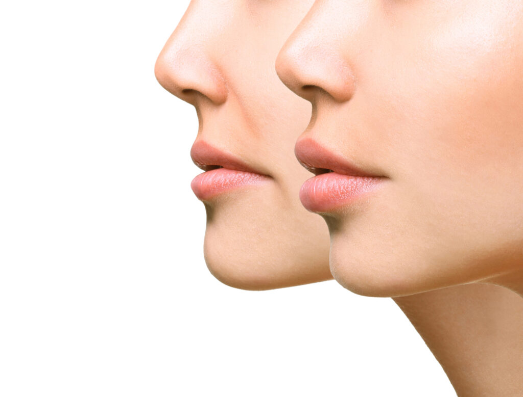 Dermal Fillers Delaware | Premier Cosmetic Surgery DE