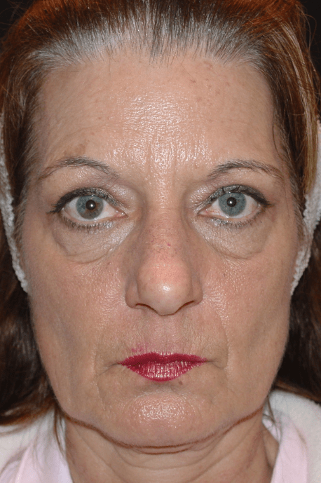 Mid Face Lift Delaware | Premier Cosmetic Surgery DE