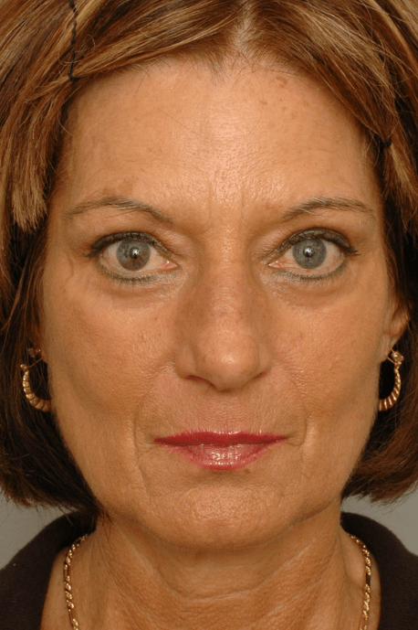 Mid Face Lift Delaware | Premier Cosmetic Surgery DE