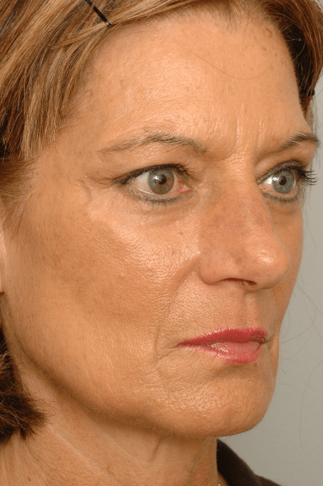 Mid Face Lift Delaware | Premier Cosmetic Surgery DE