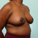 Breast Reduction Delaware | Premier Cosmetic Surgery DE