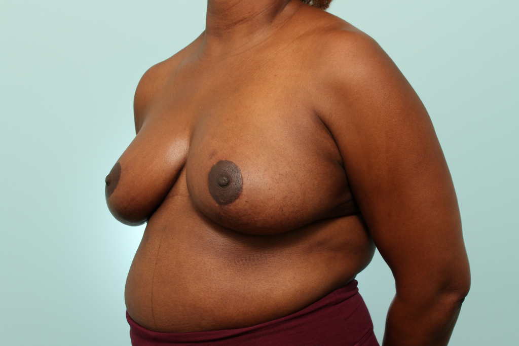 Breast Reduction Delaware | Premier Cosmetic Surgery DE