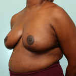 Breast Reduction Delaware | Premier Cosmetic Surgery DE