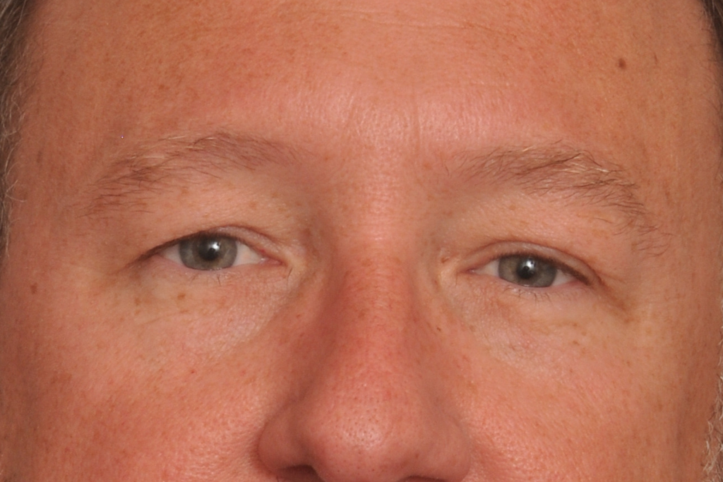 Blepharoplasty Eyelid Surgery Delaware | Premier Cosmetic Surgery DE