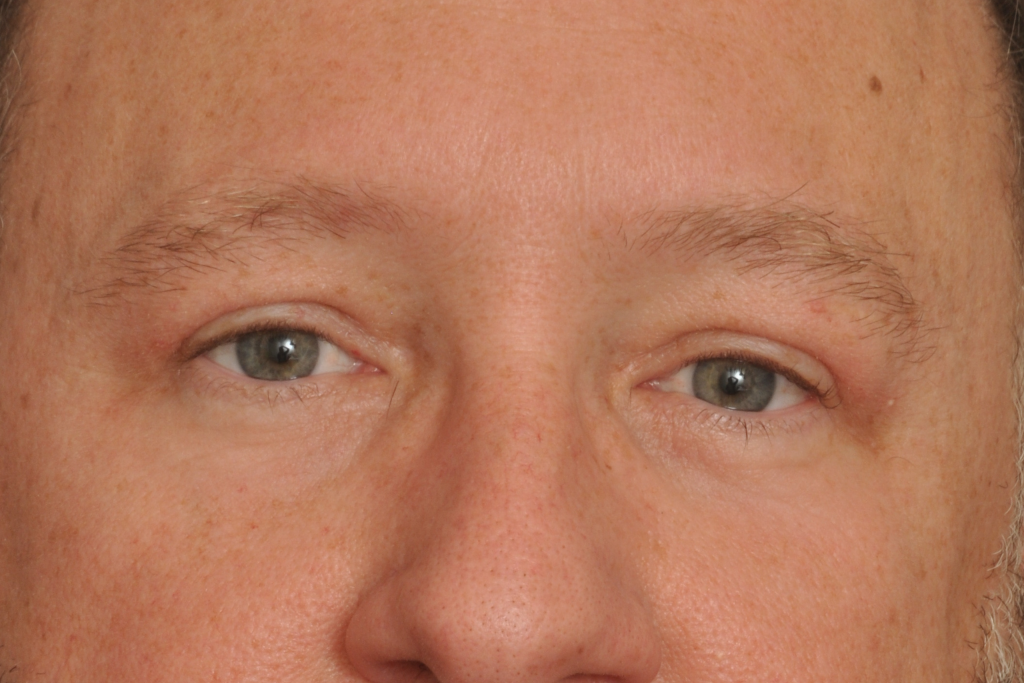 Blepharoplasty Eyelid Surgery Delaware | Premier Cosmetic Surgery DE