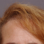 Hair Restoration Delaware | Premier Cosmetic Surgery DE