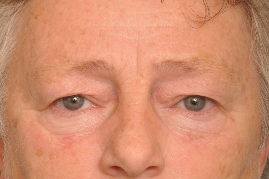 Blepharoplasty Eyelid Surgery Delaware | Premier Cosmetic Surgery DE