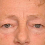 Blepharoplasty Eyelid Surgery Delaware | Premier Cosmetic Surgery DE