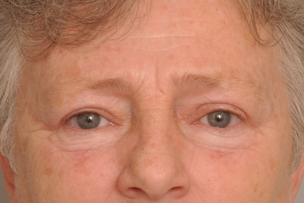 Blepharoplasty Eyelid Surgery Delaware | Premier Cosmetic Surgery DE