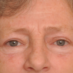 Blepharoplasty Eyelid Surgery Delaware | Premier Cosmetic Surgery DE