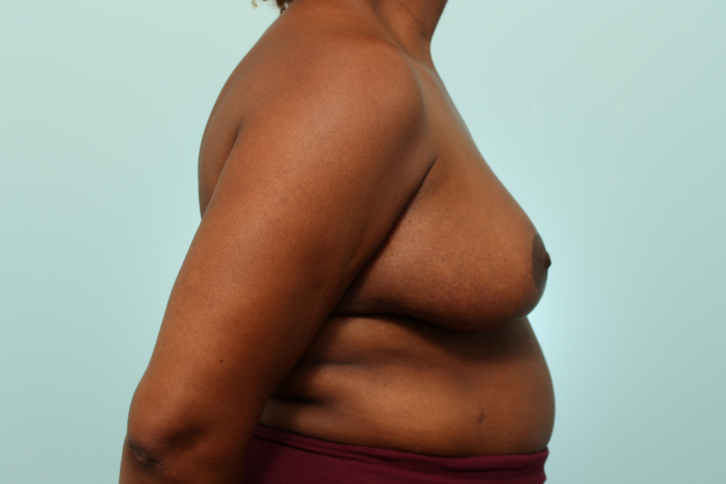 Breast Reduction Delaware | Premier Cosmetic Surgery DE