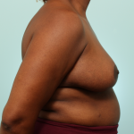 Breast Reduction Delaware | Premier Cosmetic Surgery DE