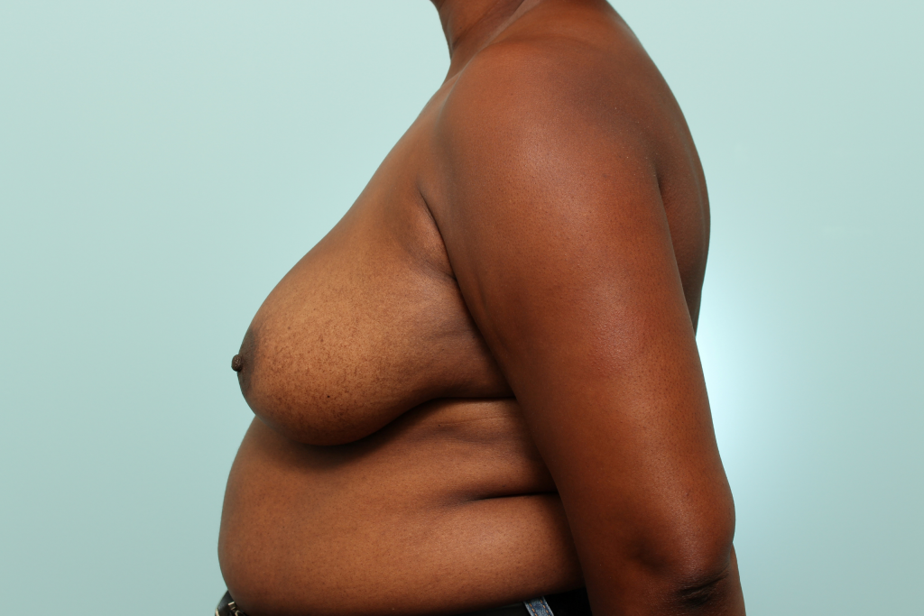 Breast Reduction Delaware | Premier Cosmetic Surgery DE