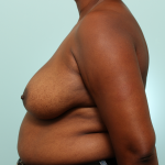 Breast Reduction Delaware | Premier Cosmetic Surgery DE