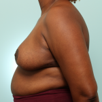 Breast Reduction Delaware | Premier Cosmetic Surgery DE