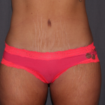 Tummy Tuck Delaware | Premier Cosmetic Surgery DE