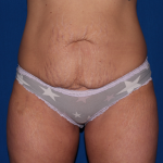 Tummy Tuck Delaware | Premier Cosmetic Surgery DE