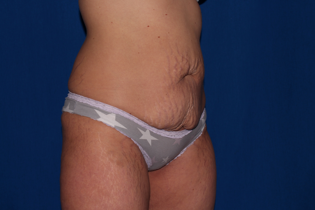 Tummy Tuck Delaware | Premier Cosmetic Surgery DE