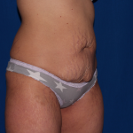 Tummy Tuck Delaware | Premier Cosmetic Surgery DE