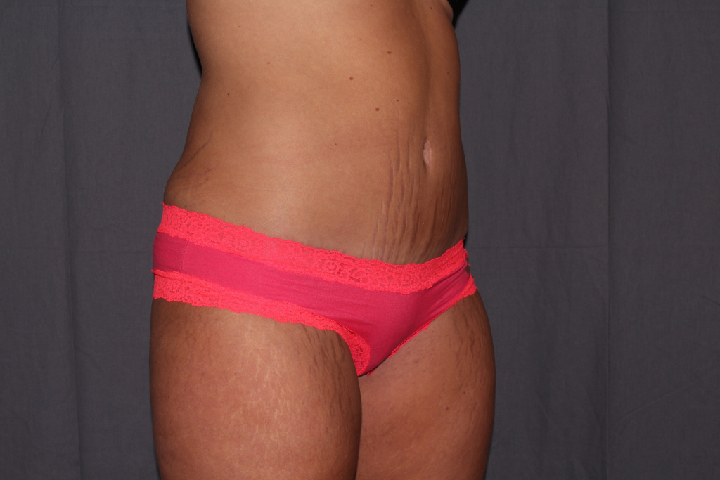 Tummy Tuck Delaware | Premier Cosmetic Surgery DE