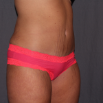 Tummy Tuck Delaware | Premier Cosmetic Surgery DE