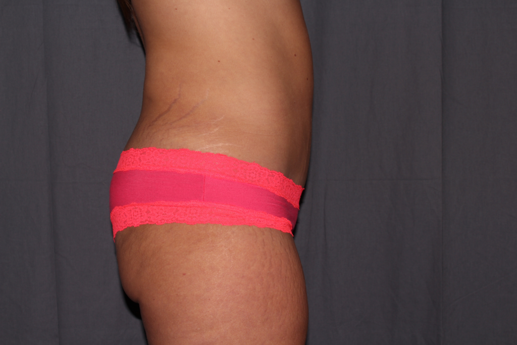 Tummy Tuck Delaware | Premier Cosmetic Surgery DE