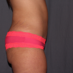 Tummy Tuck Delaware | Premier Cosmetic Surgery DE