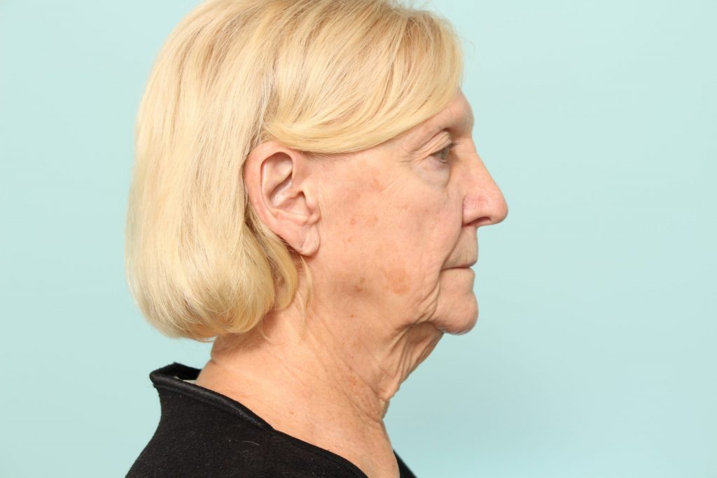 Neck Lift Newark DE | Premier Cosmetic Surgery DE