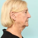 Neck Lift Newark DE | Premier Cosmetic Surgery DE