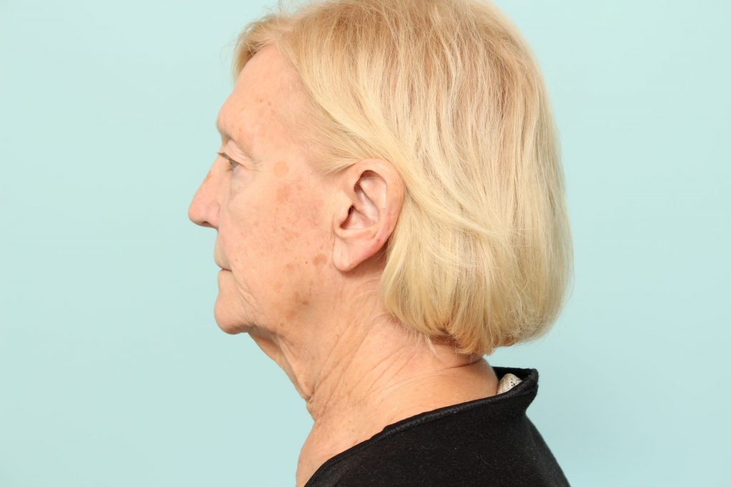 Neck Lift Newark DE | Premier Cosmetic Surgery DE