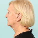 Neck Lift Newark DE | Premier Cosmetic Surgery DE