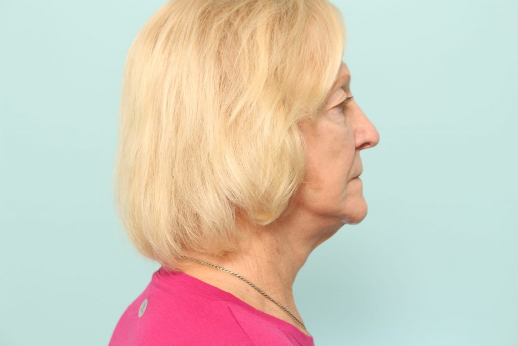 Neck Lift Newark DE | Premier Cosmetic Surgery DE