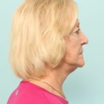 Neck Lift Newark DE | Premier Cosmetic Surgery DE